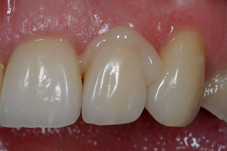 Current Concepts in Cementation