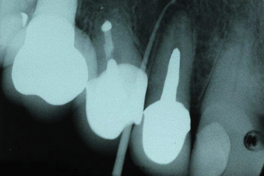 A Multidisciplinary Approach to Endodontic Treatment of the Compromised Tooth