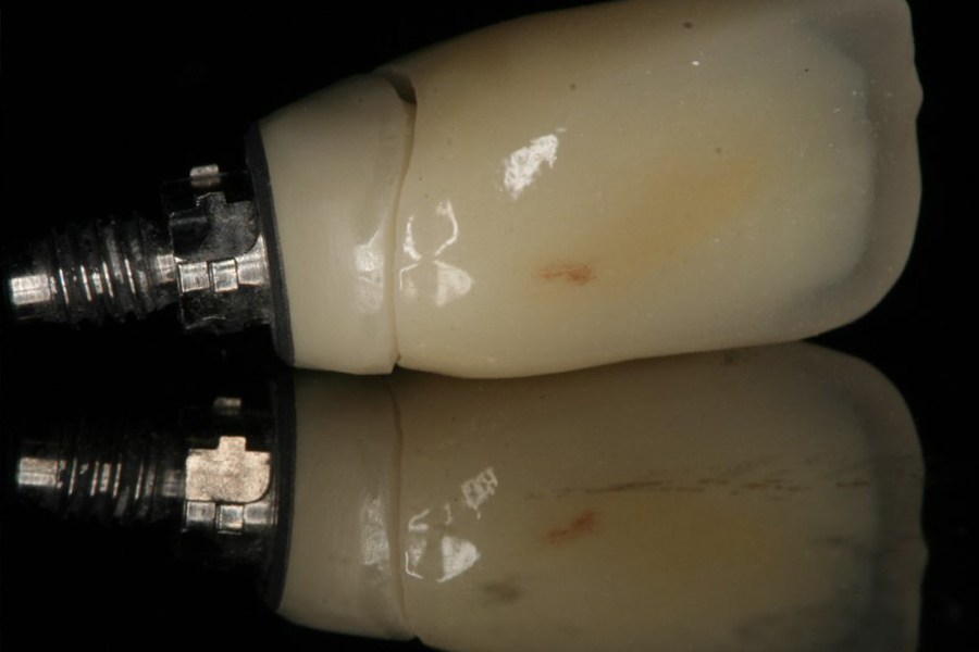Prosthodontic Management of Implants