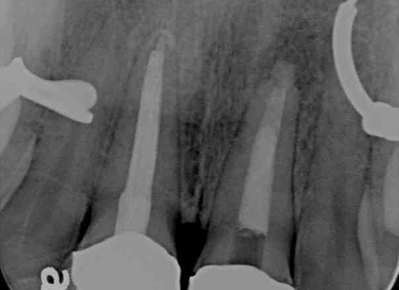 Using Calcium Silicates in Endodontics and Surgical Endodontics