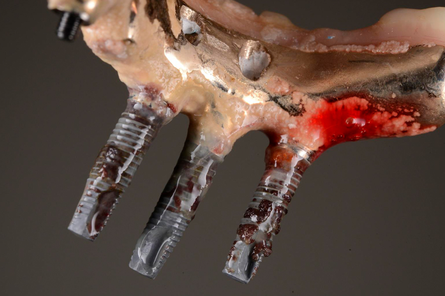 Managing Implant Complications