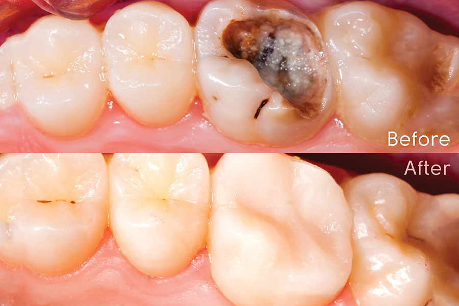 Direct and Indirect Resin Composite Restorations