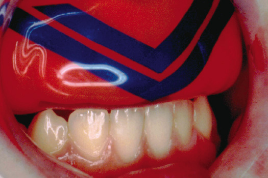 Modern Mouthguards - Providing Protection for Your Patients