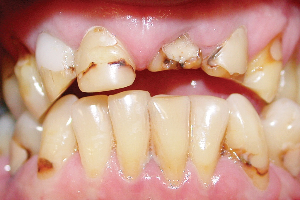 Conservative Management of the Severely Worn Dentition