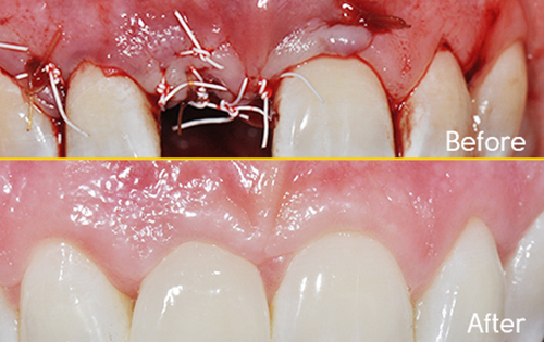 Surgical Skills for Implant Dentistry: Soft Tissue Management, Extractions and Ridge Preservation