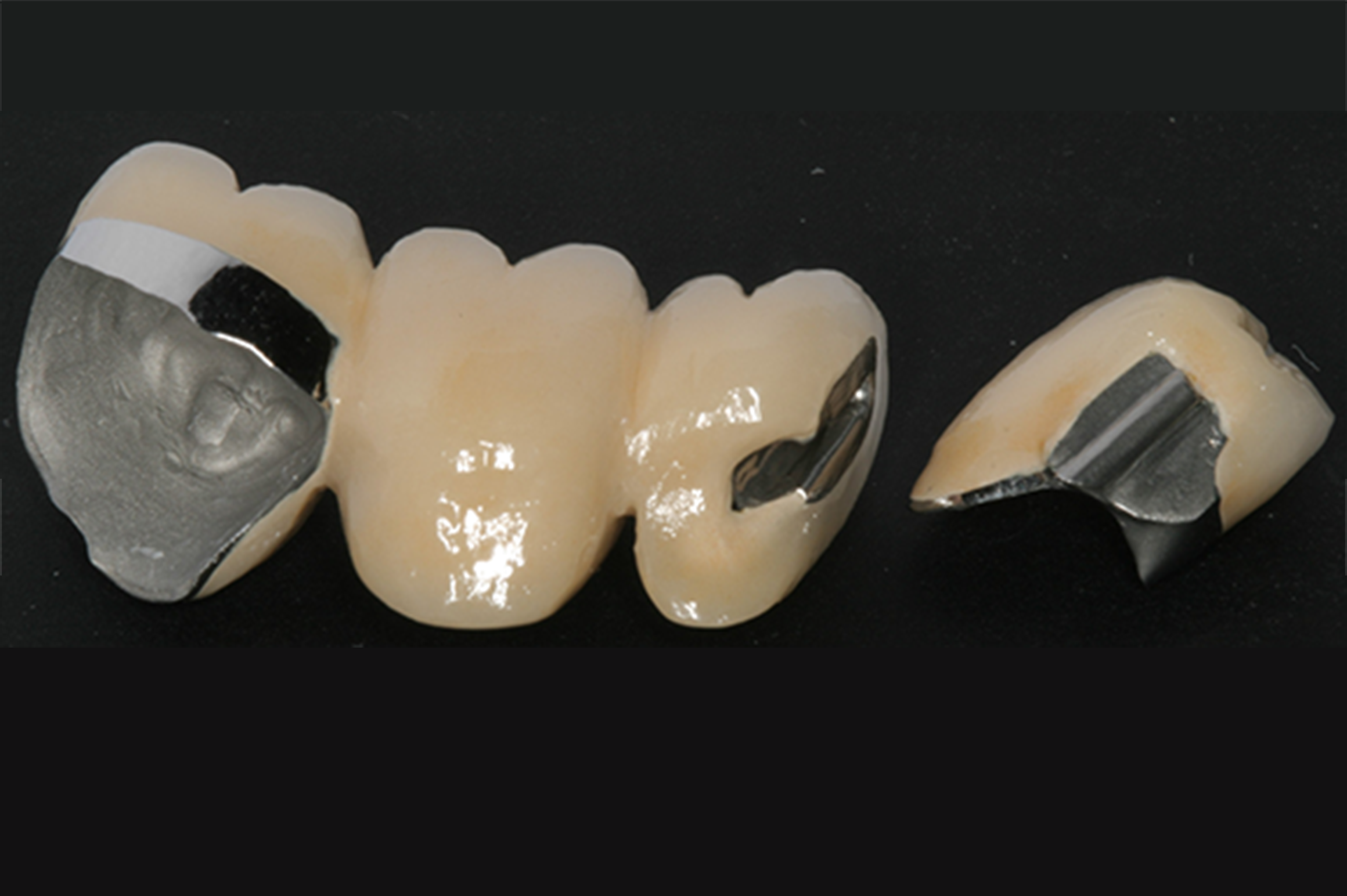 Resin Bonded and Traditionally Retained Tooth Bridges  