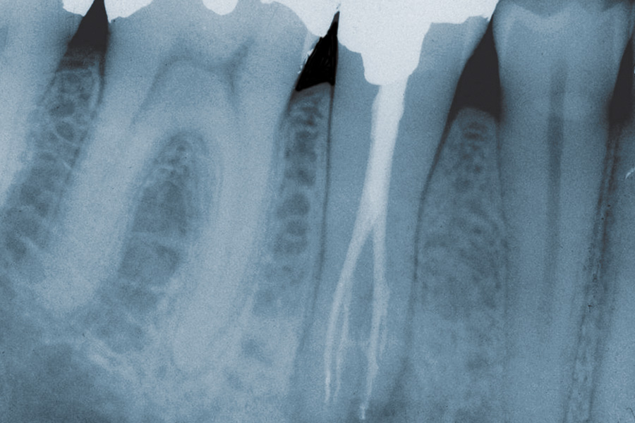Maximising Endodontic Success