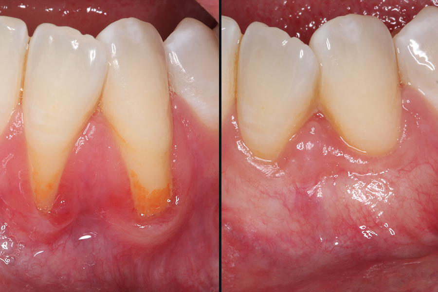 Soft and Hard Tissue Management Around Teeth and Implants