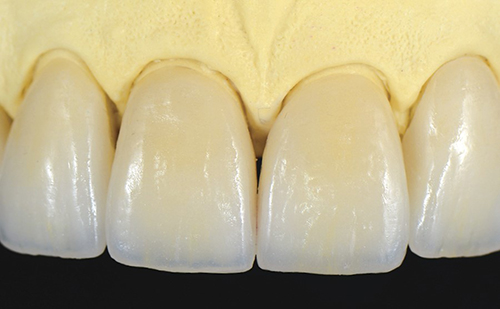 All-Ceramic Crowns and Veneers in the Aesthetic Practice