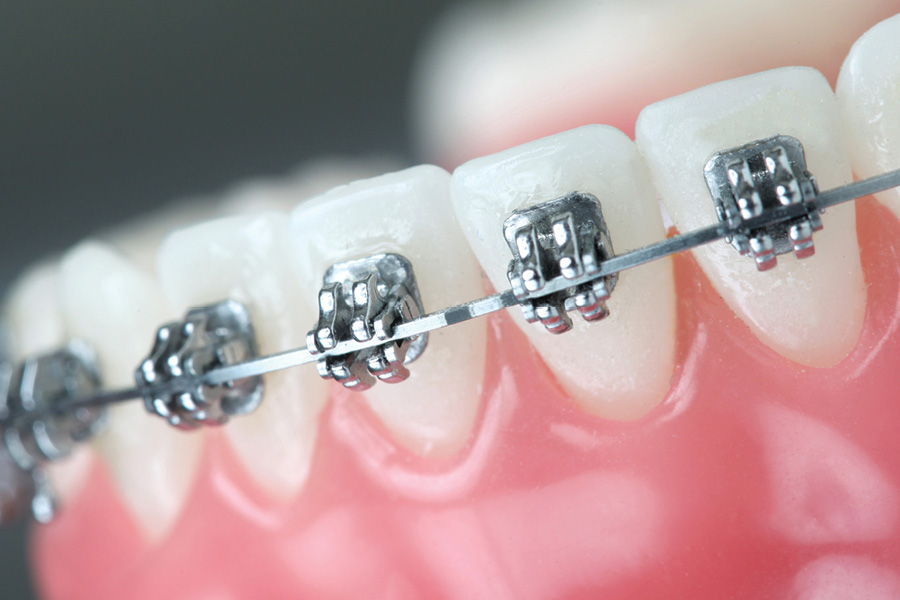 Simplified Common Sense Orthodontic Biomechanics