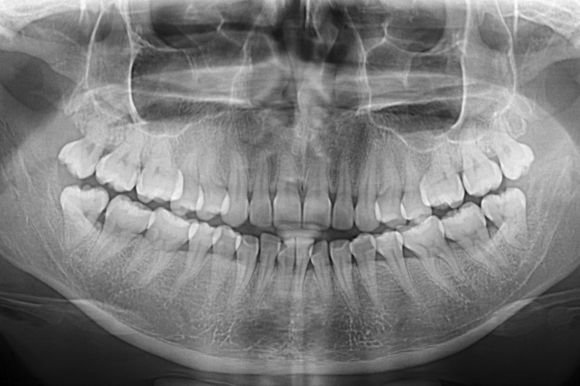 Panoramic Radiographs: A Systematic Review