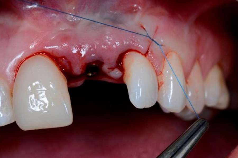 Modern Surgical Concepts for Aesthetic and Implant Dentistry