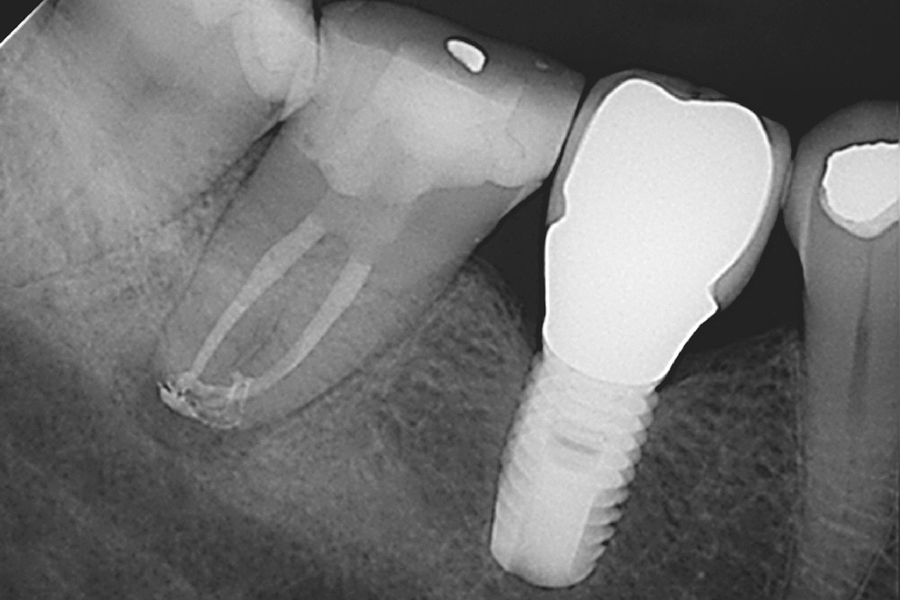 Endodontics in the Era of Implants