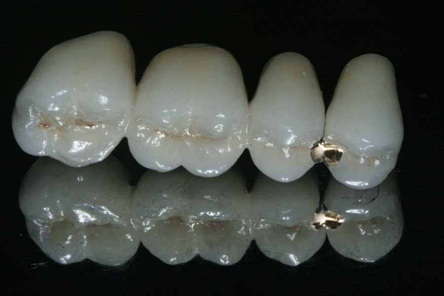 Contemporary Dental Bridges