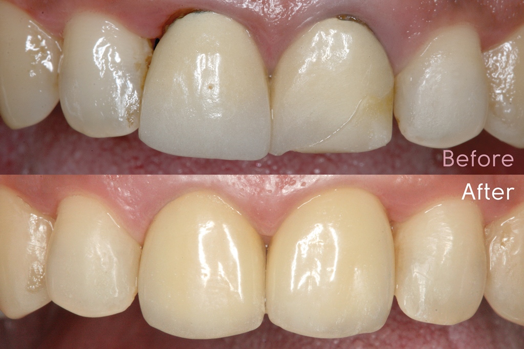 The A-Z of Mastering Anterior Crowns