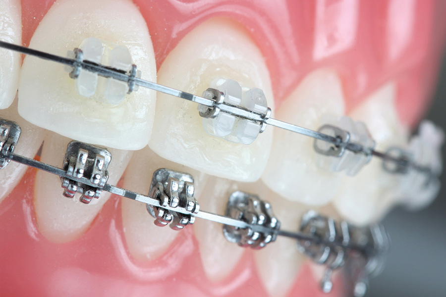 Advanced Orthodontic Biomechanics & Treatment Solutions