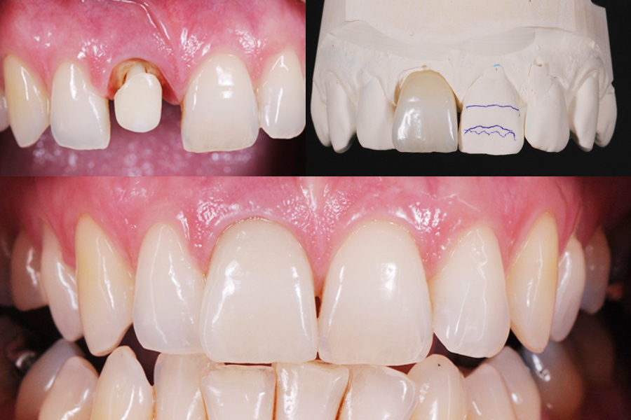 Update in Restorative Dentistry