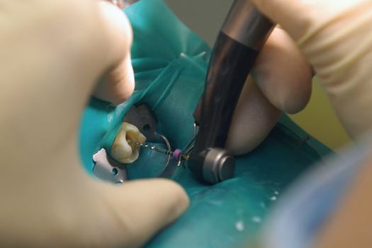 Achieving Effective Root Canal Treatment
